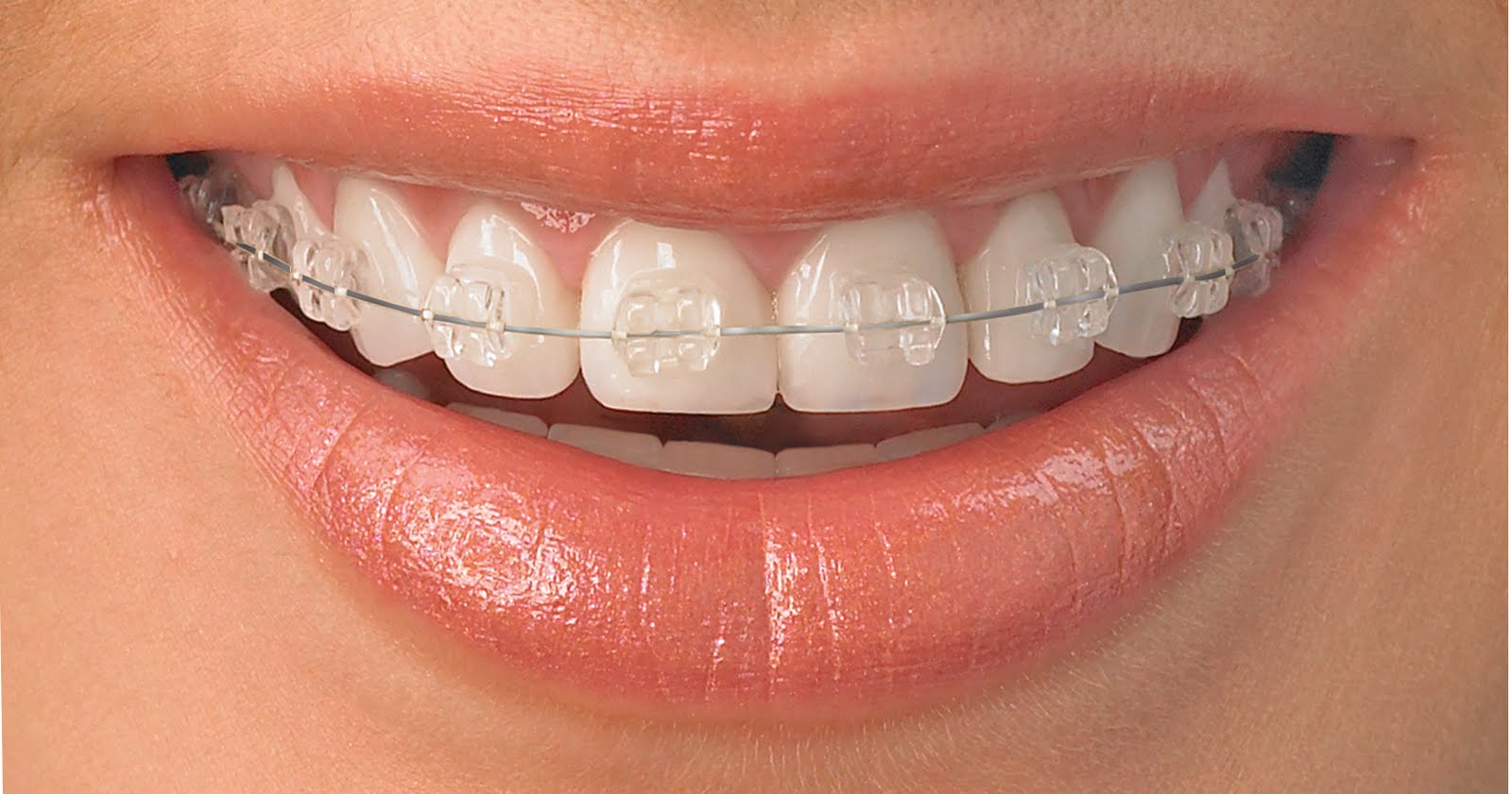 Clear Braces Adults 84